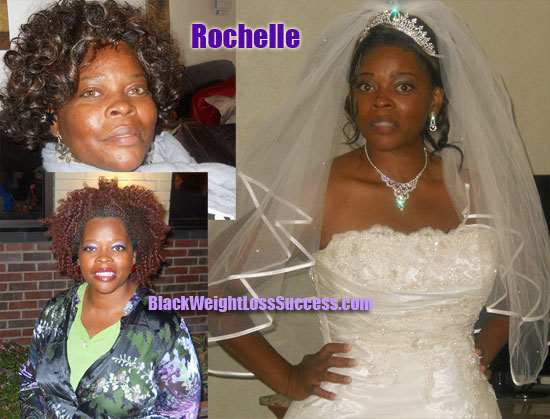 Rochelle weight loss surgery