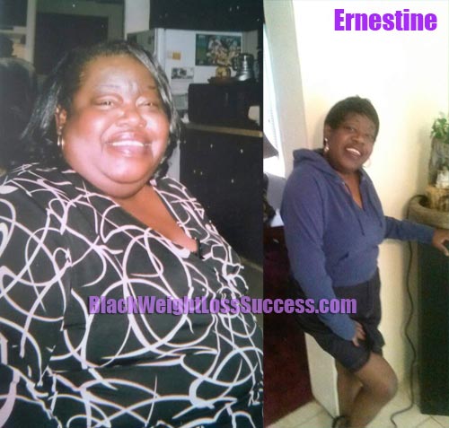 Ernestine weight loss surgery