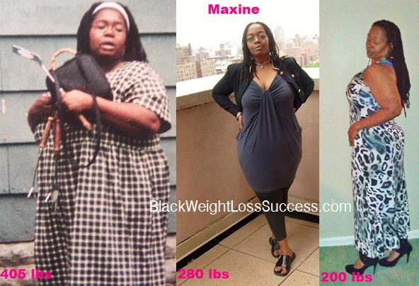 Maxine lapband weight loss surgery