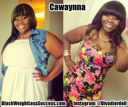 Cawaynna weight loss surgery