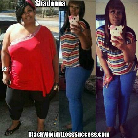 Shadonna weight loss surgery