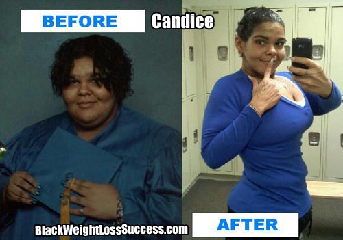 Candice extreme weight loss