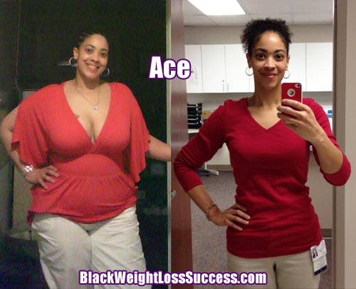 Ace weight loss surgery