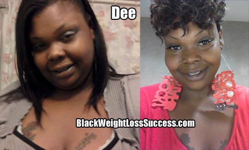 Dee weight loss surgery