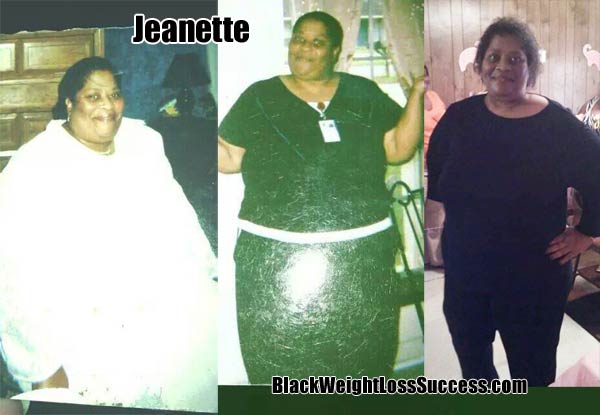 Jeanette weight loss surgery