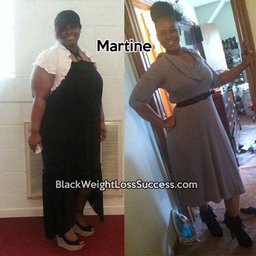 martine weight loss surgery