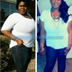 Valerie weight loss surgery