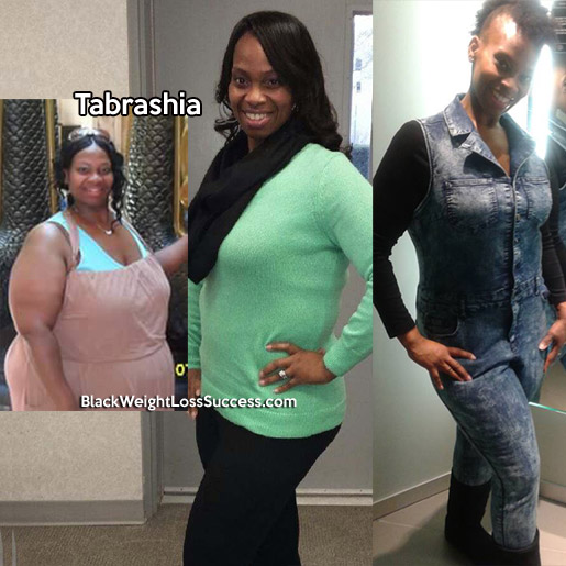 before and after weight loss surgery pictures