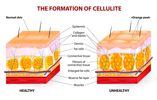 Top Guidelines Of What Is Cellulite? Causes + Natural Ways To Get Rid ... - Vitacost thumbnail