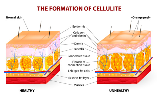 An Unbiased View of Get Rid Of Cellulite • Glutes Workout + 4 Diet Tips thumbnail