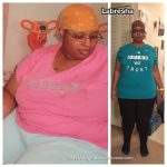 Labresha before and after