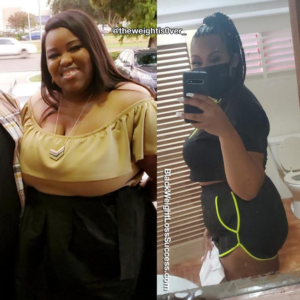Vertical Sleeve Gastrectomy | Black Weight Loss Success