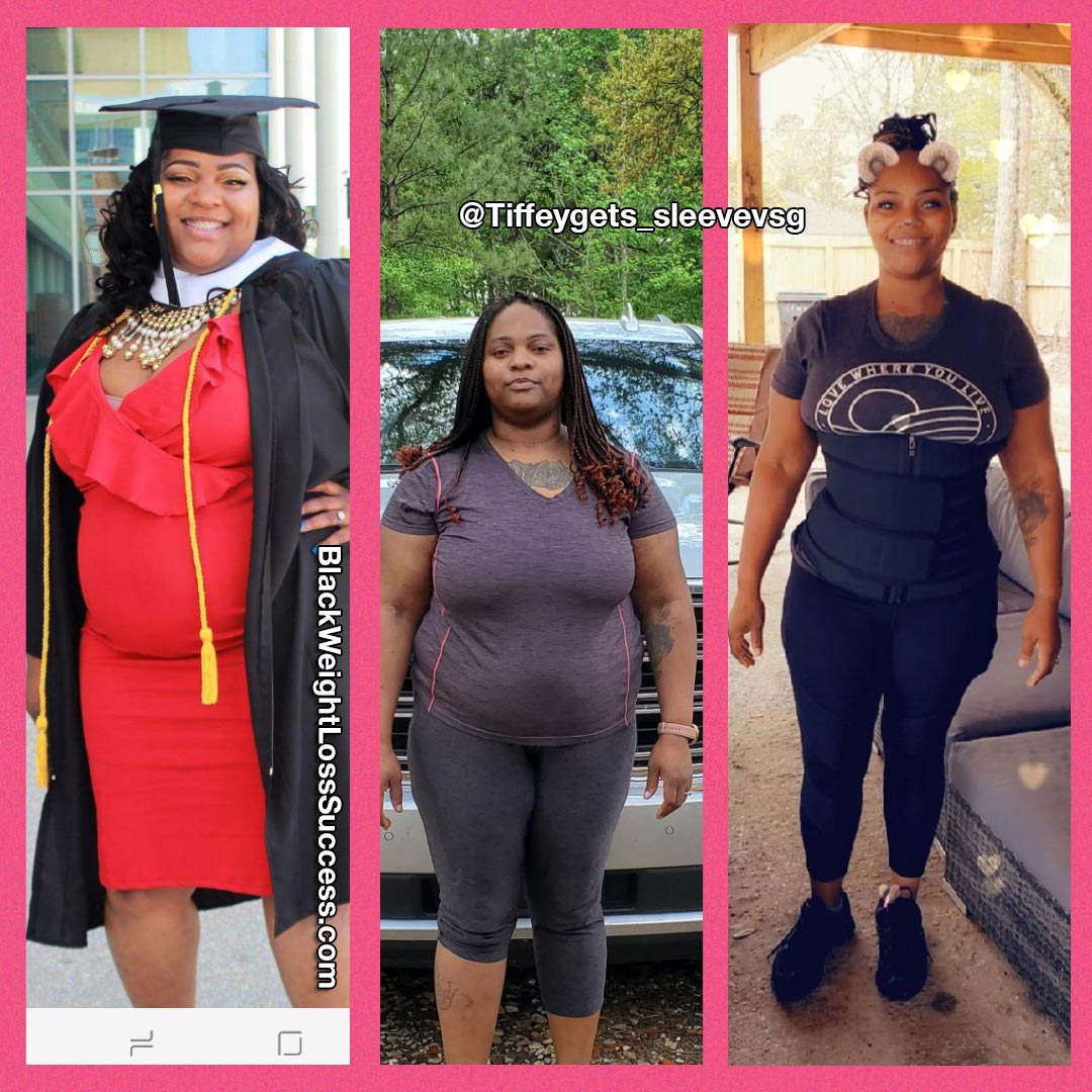 gastric bypass before and after black women