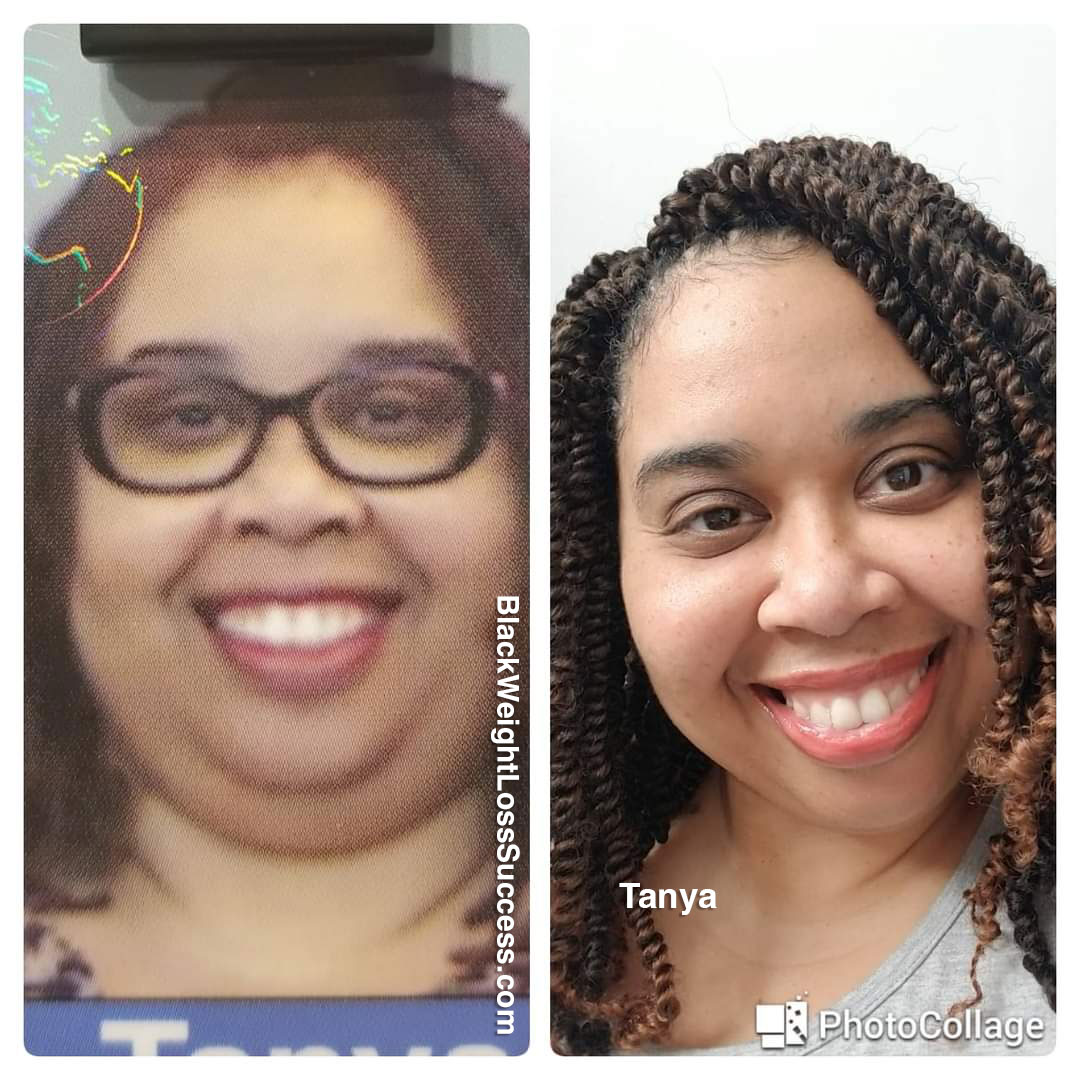 Tanya before and after VSG surgery